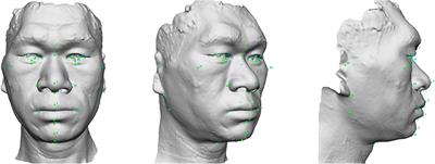 Identifying Facial Features and Predicting Patients of Acromegaly Using Three-Dimensional Imaging Techniques and Machine Learning